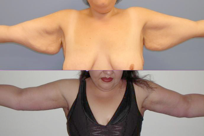 Before and After Arm Lift Surgery