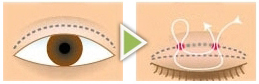 Non-incisional Double Eyelid Surgery