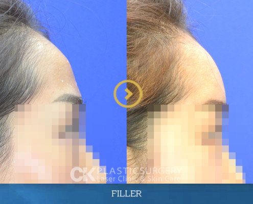 Before and After Filler