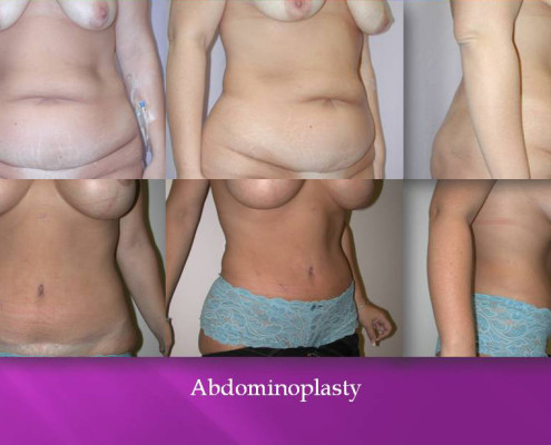 Abdominoplasty by Dr. Charles Kim