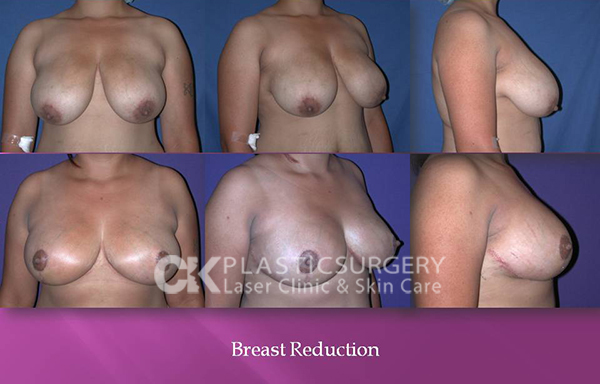 Breast Reduction in CA