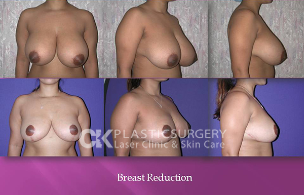 Breast Reduction in Costa Mesa