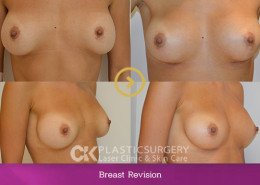 Breast Implant Revision Los Angeles