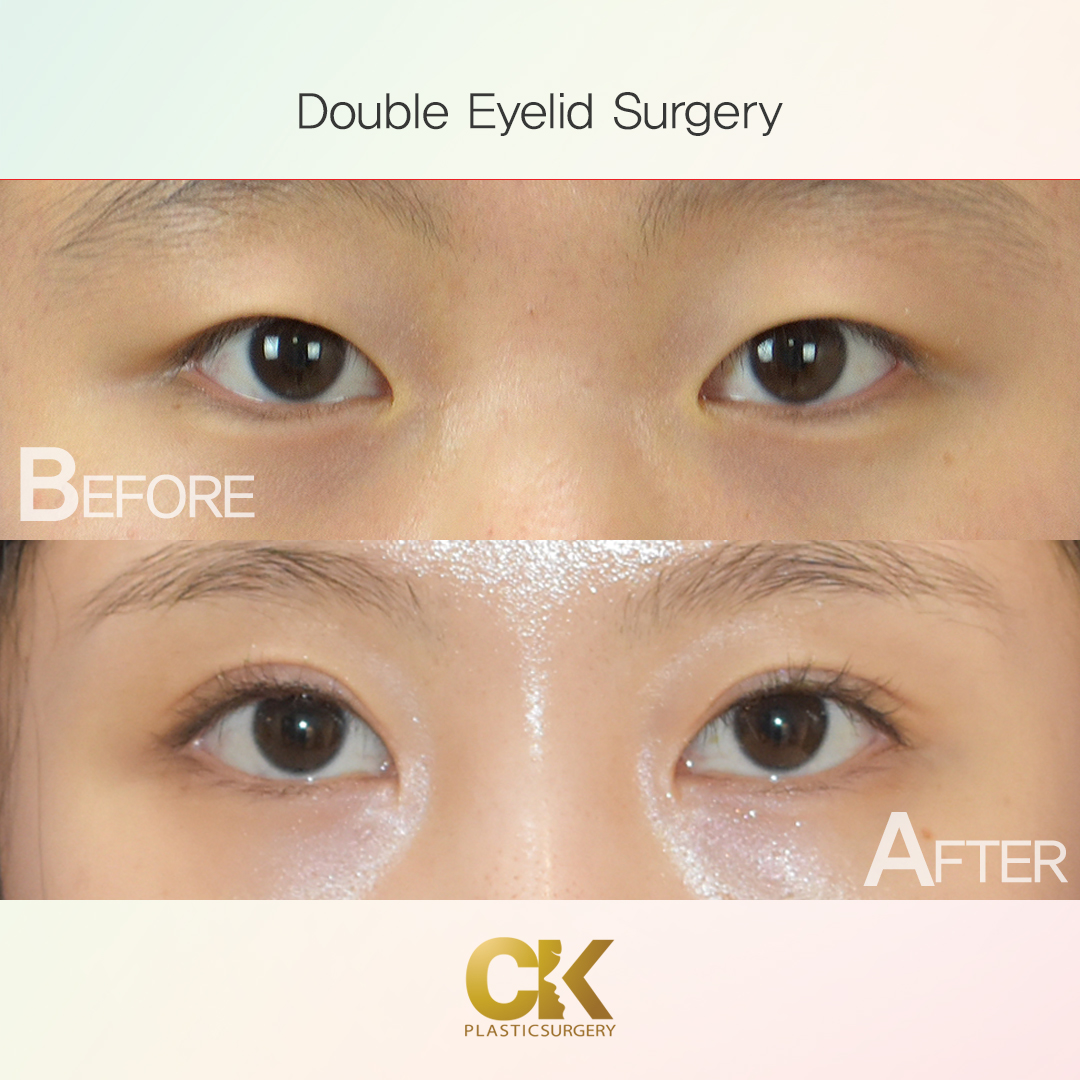 Double Eyelid Surgery in LA