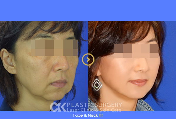 Non-Surgical Facelift Los Angeles