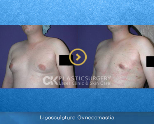 Male Breast-Reduction Surgery