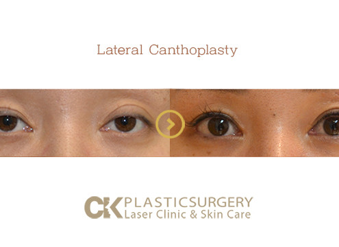 Lateral Canthoplasty Los Angeles