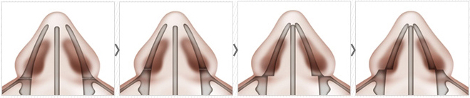 Rhinoplasty by Nose Type_2