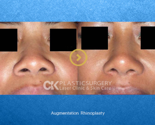 Rhinoplasty for a Flat Nose