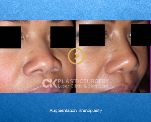 Rhinoplasty for a Flat Nose in CA