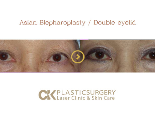 Asian Blepharoplasty Los Angeles