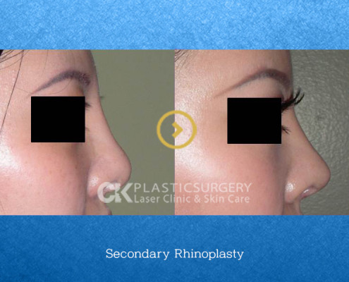 Rhinoplasty by Nose Type