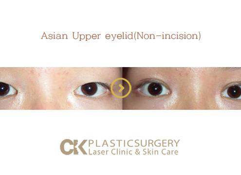 Asian Upper Eyelid Surgery