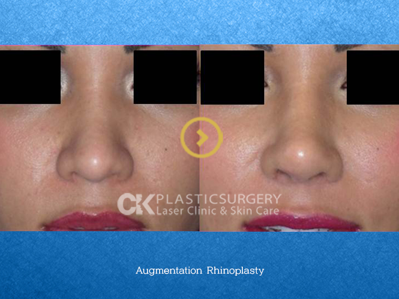 Nose Augmentation Surgery