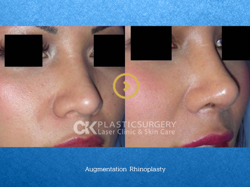 Asian Augmentation Nose Surgery