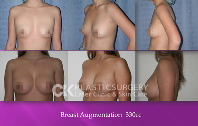 Breast Augmentation Los Angeles