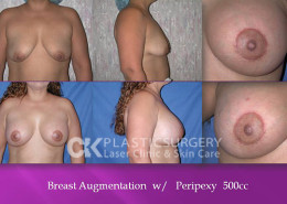 Breast Surgery Orange County