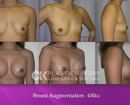 Breast Augmentation CA Los Angeles