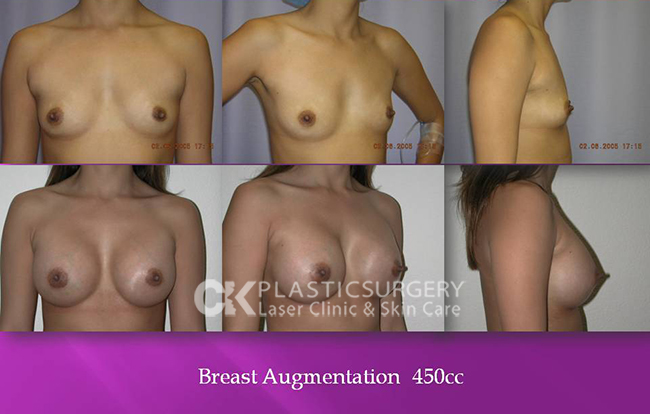 Breast Augmentation CA Los Angeles