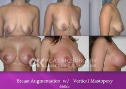 Breastlift Surgery