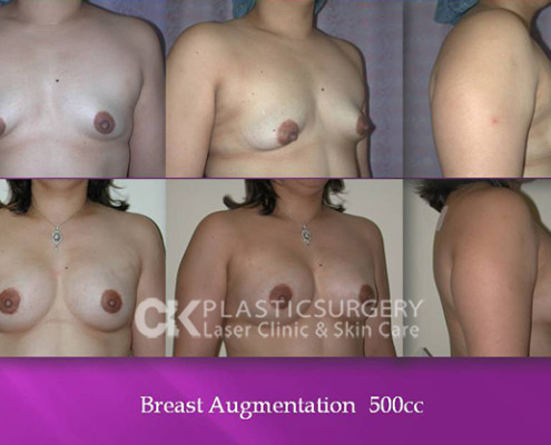 Natural Breast Augmentation Los Angeles