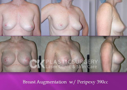 Breast Lift in Beverly Hills, CA