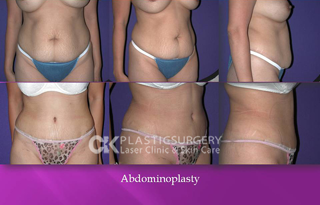 Abdominoplasty Surgery Los Angeles