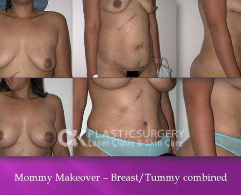 Breast and Tummy Tuck