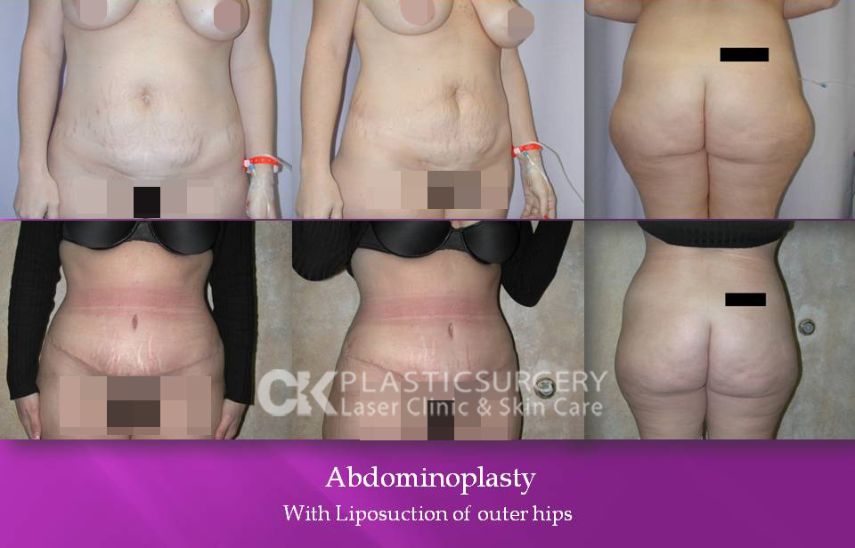 Abdominoplasty in Orange County