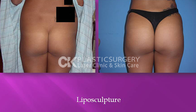 Before and After Liposuction