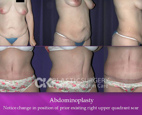 Abdominoplasty – Before and After