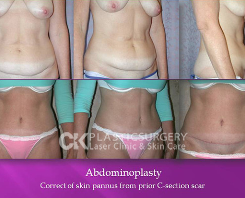Abdominoplasty (Tummy Tuck) Procedure