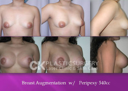 Breast Lift Cost in Los Angeles
