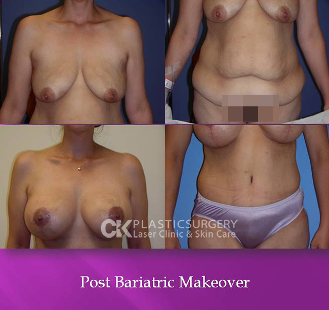 Post Bariatric Gallery
