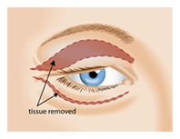 Eyelid Surgery by Incisional Method