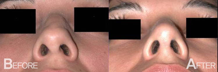 Nasal Tip Plasty Before and After