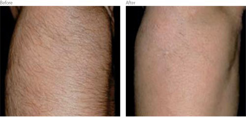 Lumenis Before After
